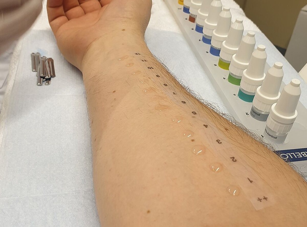 Skin prick test with numbered allergen drops on the forearm