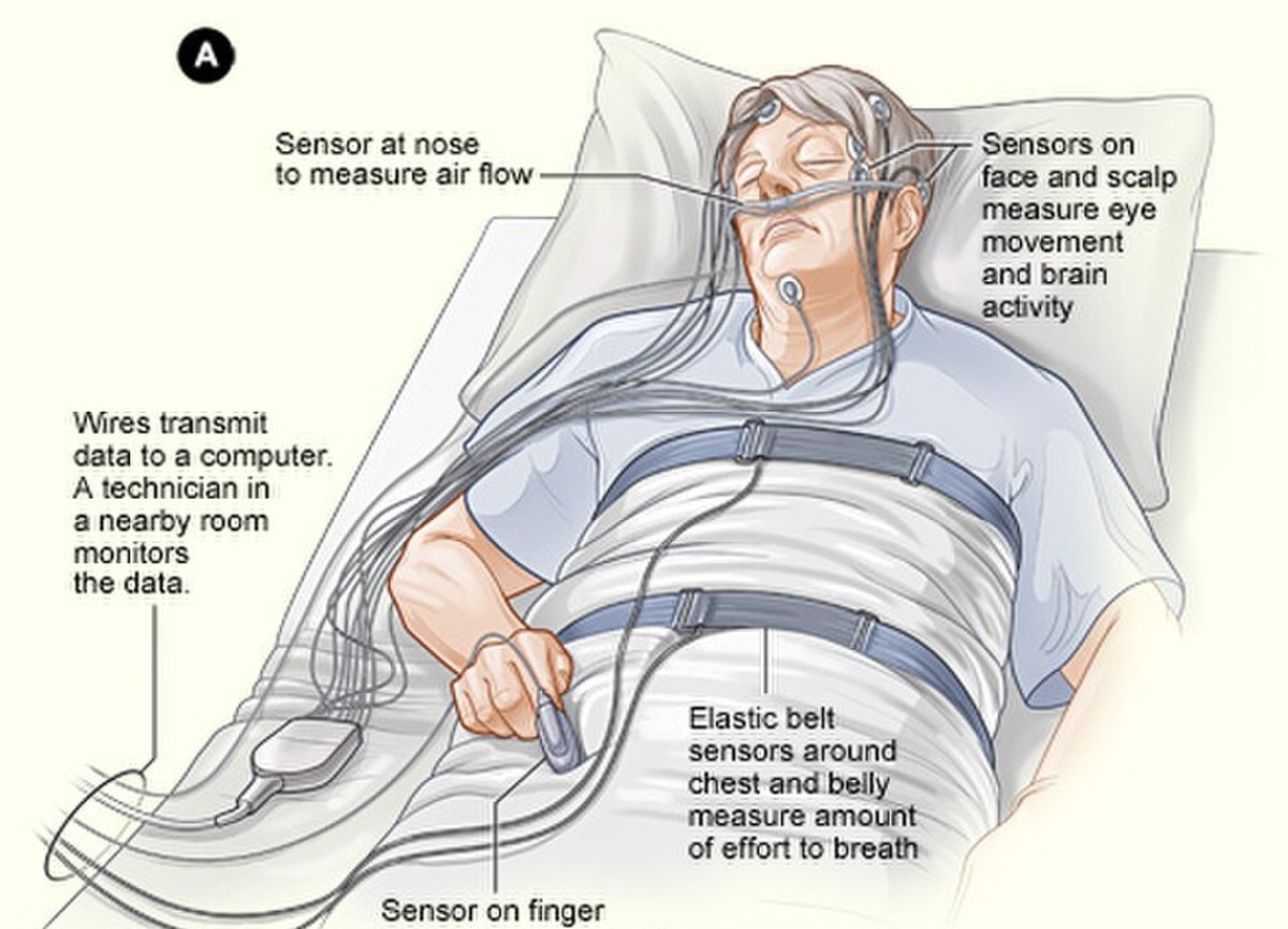 Illustration of a sleep study with breathing and oxygen sensors